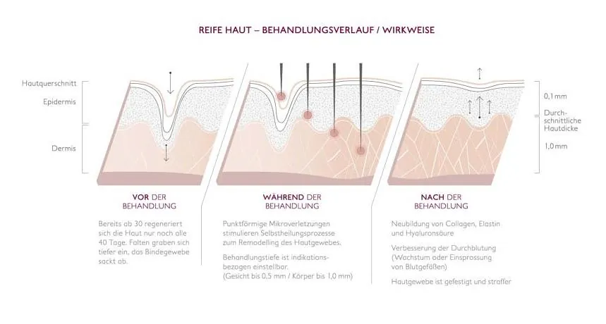 Micro-needling